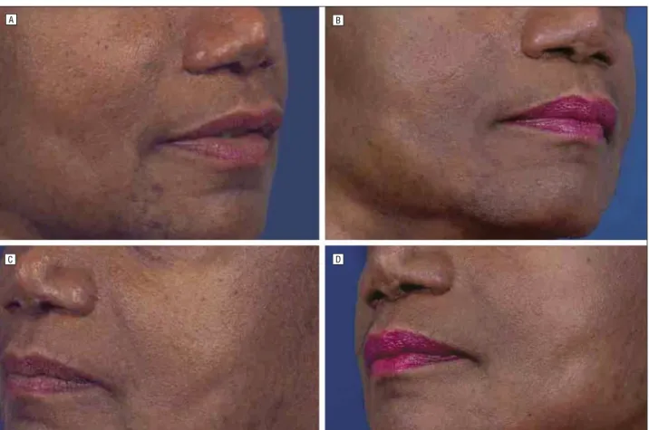Figure 7. Preoperative (A and C) and postoperative (B and D) views of a patient in whom the malar fat pad elevation technique was used to elevate the lateral wall.