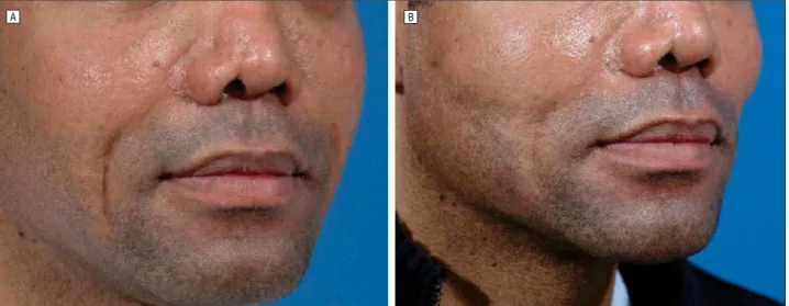 Figure 8. Preoperative (A) and postoperative (B) views of a patient in whom the threading technique was used to elevate the lateral wall.