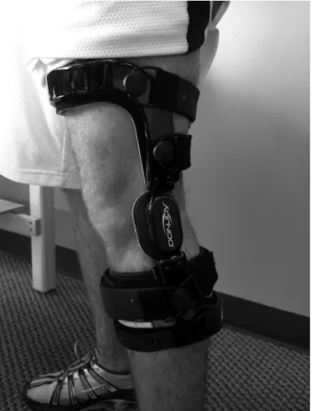 FIGURE 9. An osteoarthritis unloading brace (OA Defiance; DonJoy Corporation, Vista, CA) using a 4-point leverage system to unload the medial compartment of the knee by providing a mild valgus stress to the knee.
