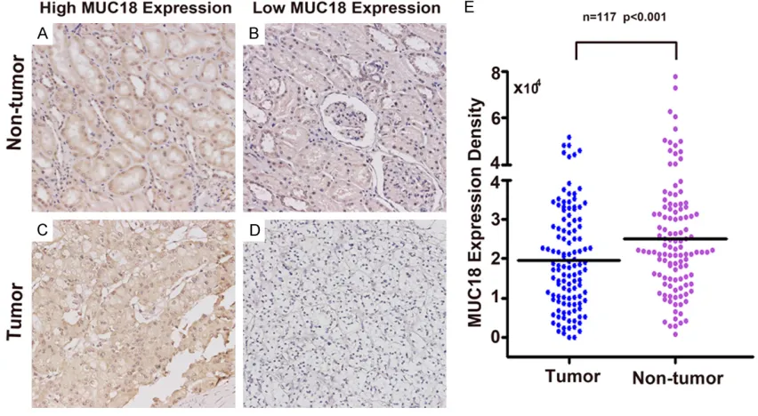 Figure 1. Immunohistochemical analysis of MUC18 expression in ccRCC. A: High MUC18 expression in non-tumor tissue; B: Low MUC18 expression in non-tumor tissue; C: High MUC18 expression in tumor tissue; D: Low MUC18 expression in tumor tissue; E: IOD score 