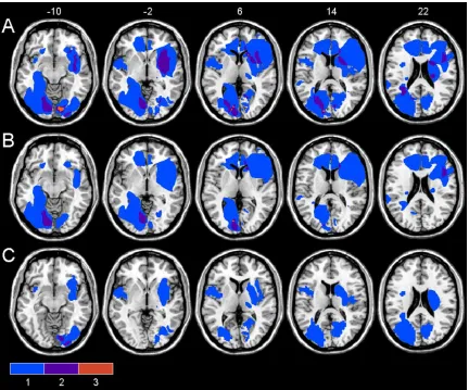 Figure 2.  Simple overlap of the individual lesions for the brain damaged control group