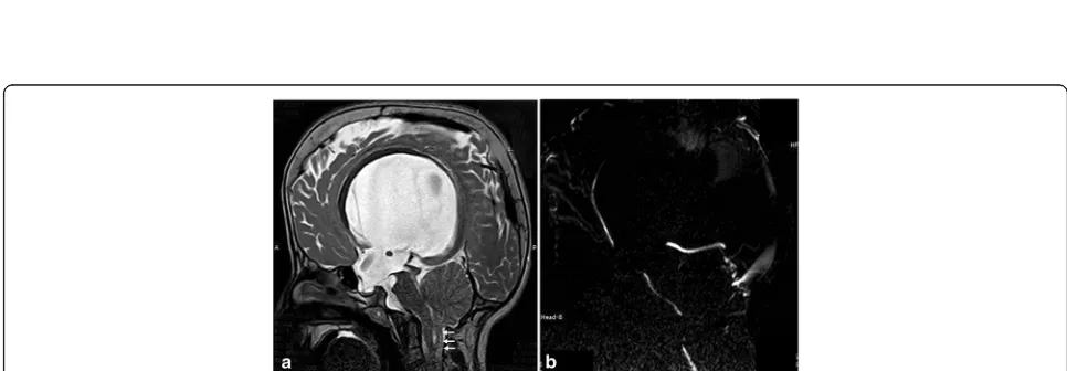 Fig. 16 A 3-month-old boy with Dandy-Walker malformation with hydrocephalus. a 3D-DRIVE showing large posterior fossa, cerebellarhypoplasia, and stenosis of the aqueduct of Sylvius