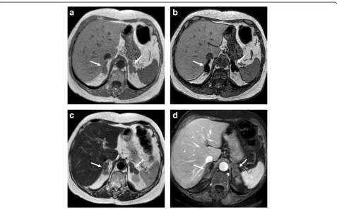 Fig. 2 Bilateral adrenal hyperplasia in a 75-year-old woman. Axial T1-weighted in-phase (weighted fast spin echo (a) and out-of-phase gradient recalled echo (c), T2-c), and three dimensional fat-suppressed T1-weighted gradient recalled echo image in portal phase after contrastinjection (d) show the nodular enlargement of both adrenal glands (arrows) with loss of signal on out-of-phase (b)