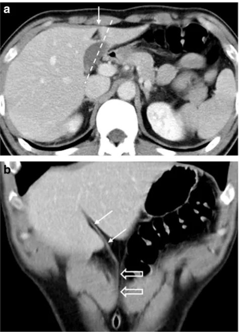 Fig. 2 Contrast-enhanced CT scan revealing the right paramedian portalpedicle (PRPM) forming the right umbilical portion of the portal vein (star)and joining the right-sided ligamentum teres (RSLT) (dotted line), withthe middle hepatic vein (MHV) running to the left of the umbilical portionand RSLT