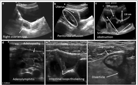 Fig. 1 Examples of abnormal ultrasound images: intestinal loops suggestive of ileitis (thickening by more than 3 mm of the wall of the digestive tract), 5 mm in terms of the antero‑posterior diameter, sensitive to passage of the probe, and enhanced by color Doppler), a a latero‑uterine mass with a sonolucent liquid content suggestive of a complicated ovarian cyst, b isolated peritoneal effusion (often at the bottom of the Douglas pouch), c appearance of a small intestinal occlusion (widening of the intestinal loops by more than 2.5 cm, with a liquid content and possible inter‑loop effusion), d adenopathies (hypoechoic oval images greater than e thickening of the last small f circumferential widening of the colon wall (a pseudo‑kidney appearance) suggestive of an inflammation or an infection