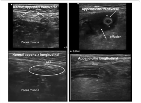Fig. 2 Ultrasound appearance of a normal appendix and a pathological one