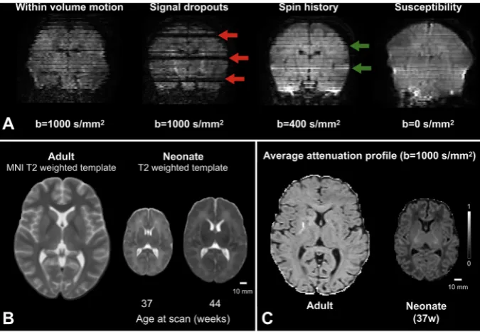 Fig.1. Overviewofsomechallengesposedbyneonatal dMRI data processing. A) An image damagedby motion causes slice misalignment due to within-volume motion, severe signal dropouts across multi-ple slices (red arrows) and signal hyper-intensities dueto spin-his