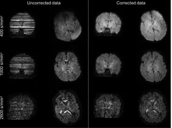 Fig. 3. Raw b0 volumes acquired using four different PE directions (LR: Left -column shows an example volume after correcting for susceptibility-induced distortions