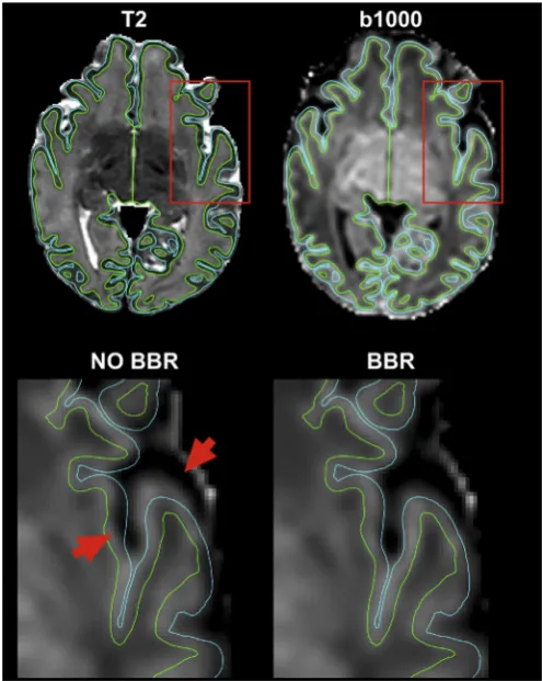 Fig. 5. The leftmost column shows sagittal views from two volumes (b ¼ 1000 s/mm2) of one subject