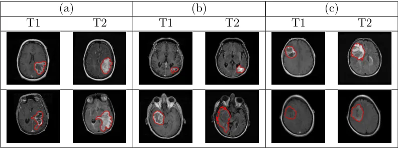 Figure 2: Examples of manually segmented tumor contours overlaid on the T1 and T2 images for patientswith (a) short (<1 month), (b) medium (≈15 months) and (c) long (> 50 months) survival
