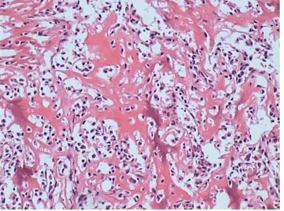 Figure 1. Chondroblastic osteosarcoma.