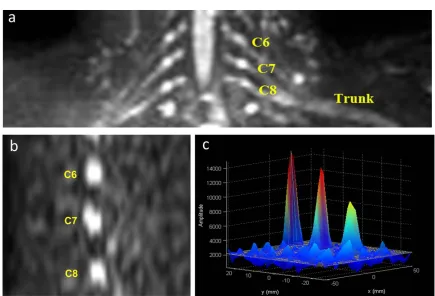 FIG. 2. (a) Coronal view MIP of brachial plexus, obtained using DWIBS with b ¼ 300 s/mm2