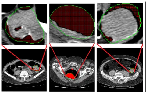 Fig. 1 Polyp heterogeneity and texture in computed tomographic colonography. The green curves are their boundaries plotted by radiologists.The air in polyp is labeled by red color