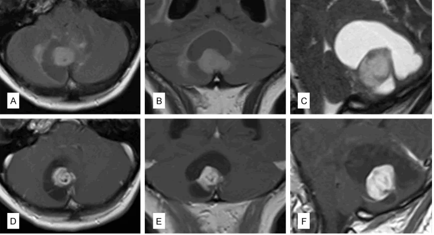 Figure 1. Preoperative imaging: Axial (A), coronal (B) FLAIR images as well as a T2-weighted sagittal scan (C) showed a nodular lesion with a cystic part in the right paramedian cerebellar hemisphere