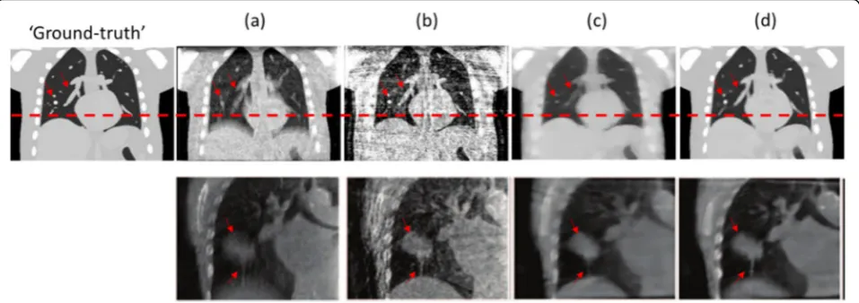 Fig. 2 Comparison between the reconstructed images by different methods.images of a real lung cancer patient from clinical projections