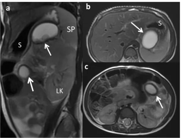 Fig. 3 Types of duplication cysts