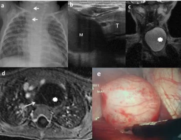 Fig. 5 A 21-week-old fetus with polyhydramnios and absent normalgastric bubble in the US is studied
