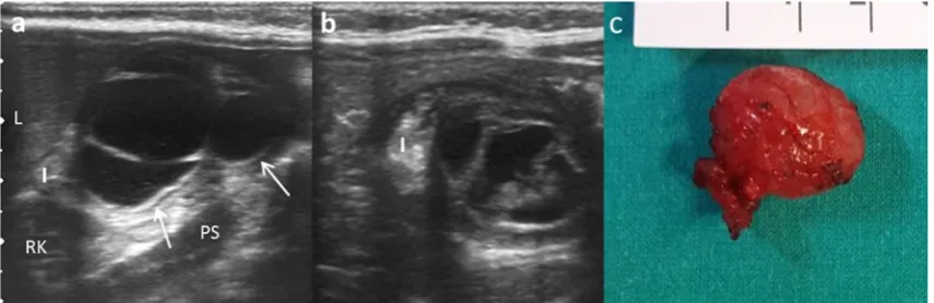 Fig. 11 An 8-month-old boy with abdominal pain and abdominal masson physical exam. a Longitudinal US view of a multiseptated cystic massin the right flank with the BY^ sign (white arrows)