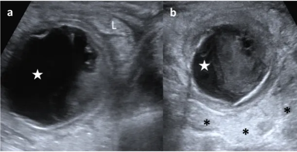 Fig. 13 A 3-year-old boy withechogenic mesenteric fat (*) as aninflammatory sign. Surgicalfindings: a 5-cm ileal complicatedduplication cyst was found withgastric mucosa withfever and abdominal pain isstudied