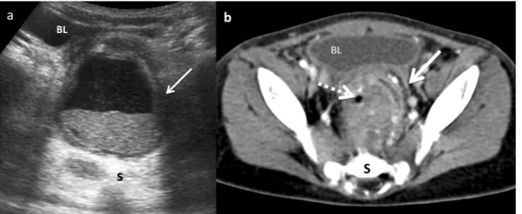 Fig. 15 A 14-month-old girl with acute gastroenteritis and continuouscrying. a Abdominal US shows an intestinal intussusception with a cyst(C) as the leading cause