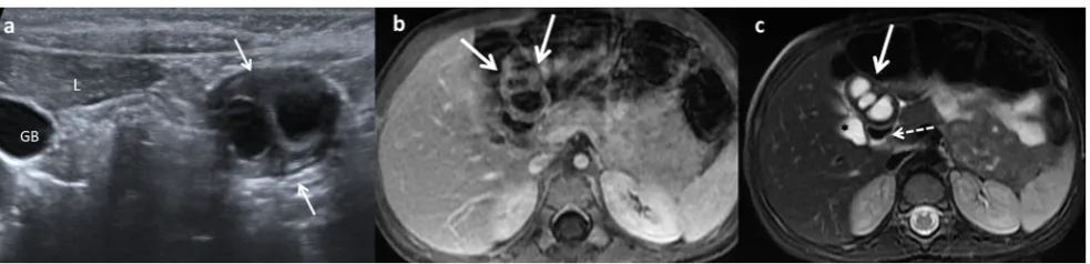 Fig. 18 A 2-year-old girl with fever and abdominal pain.T1 demonstrating the presence of a multilocular cystic mass (arrowsnext to the liver (US view of a complex cystic lesion ( a Abdominalwhite arrows) in the duodenal area,L)