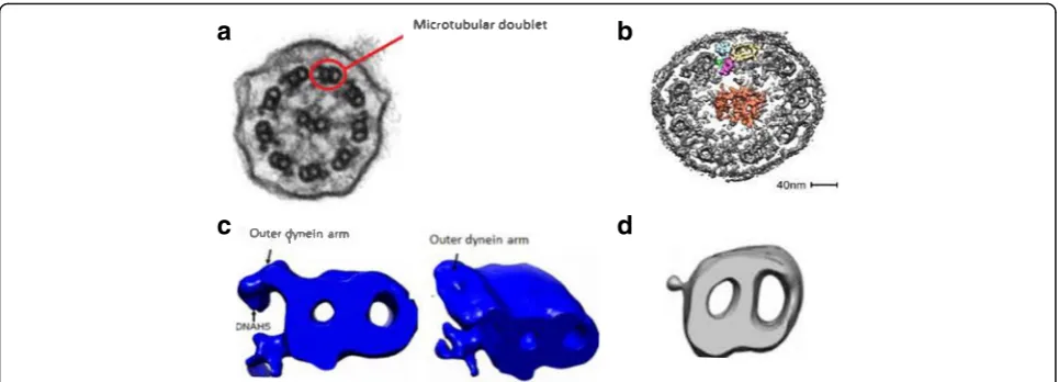 Fig. 2 CT images showing dextrocardia and middle lobe abnormalitiesin adolescent patients with PCD (above), contrasting to upper lobedisease in CF (below)