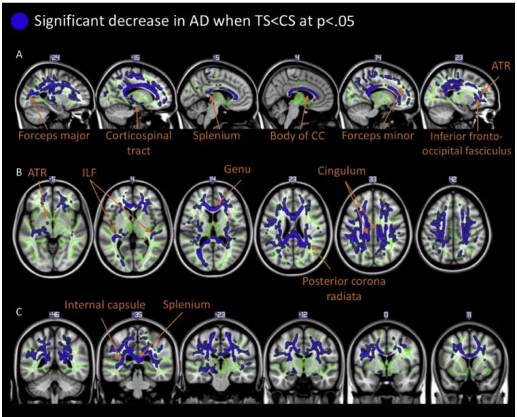 Fig. 2 e Illustrates key tracts exhibiting significant decreases in AD (p < .05 corrected for multiple comparison)