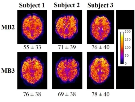 Figure 3. Spatial maps of tSNR of middle slice of the stack for each subject for sparse image 