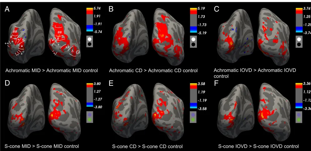 Fig. 4.Results from the whole-brain analysis showing group-levelresponse to CD and IOVD control stimuli.below the scale bar illustrate the stimulus chromaticity.(#), IPS-0 (##), LO-1 ( z-statistic maps for responses to achromatic (A–C) and S-cone (D–F) MID