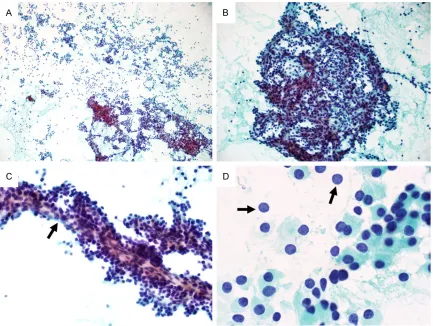 Figure 1. Conventional smears of parathyroid fine needle aspiration specimens. A. The smear is highly cellular and shows dispersed single, small uniform cells; microfollicular clusters; and loosely cohesive tissue fragments (× 100)