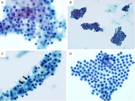 Figure 2. Architectural patterns of parathyroid fine needle aspiration specimens prepared using ThinPrep