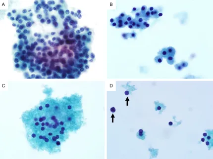 Figure 4. Parathyroid fine needle aspiration specimens prepared using ThinPrep showing stringy colloid-like mate-rial mixed with parathyroid cells (A, × 400) and capillary network (B, × 400).