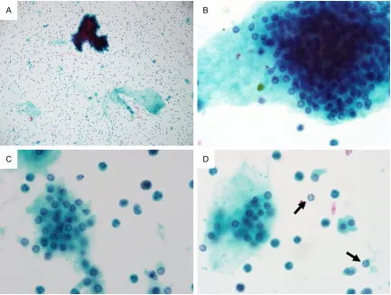Figure 5. Cytologic features of parathyroid fine needle aspiration specimens prepared using SurePath