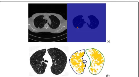 Fig. 3 Diffused tumors enhanced in breast MRI performed before (left image) and after (right image) neoadjuvant chemotherapy
