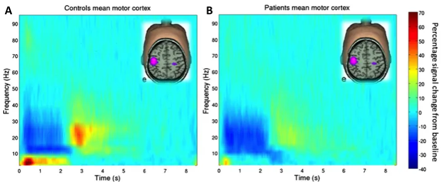 Fig. 2 The beta rebound and its disruption in patients with schizophre-nia: (tude of neural oscillations, in contralateral sensorimotor cortex, whensubjects execute a 2s finger movement