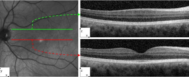 Figure 13: Two B-scans extracted from the Volume 4 sample. The left shows the en-face representation of theOCT scan with two lines (green and red) overlaid representing the corresponding locations of two B-scans withina volume present in the right.