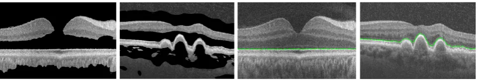 Figure 6: Detecting the IS-OS boarders in the normal and pathological subjects after image enhancement via alocal adaptive thresholding method (3.6).