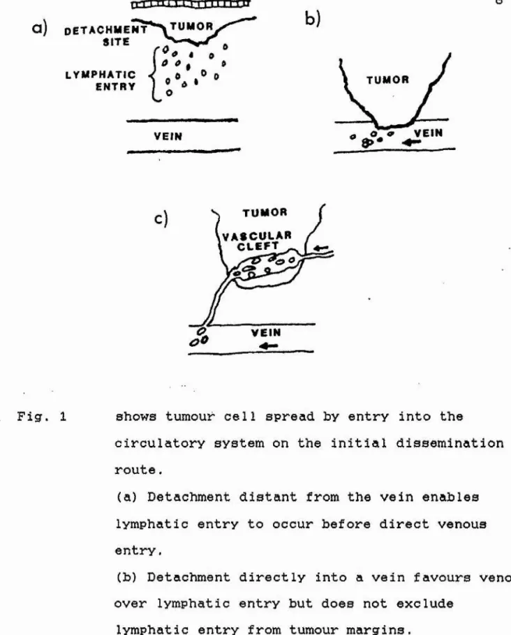 Fig.  1  shows  tumour cell  spread by entry  into  the