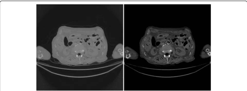Fig. 9 FBP reconstruction using linearly interpolated sinogram with old angular gap = 0.9° and new angular gap = 0.3° (1200 views over 360°).Some rotation artifacts are observed