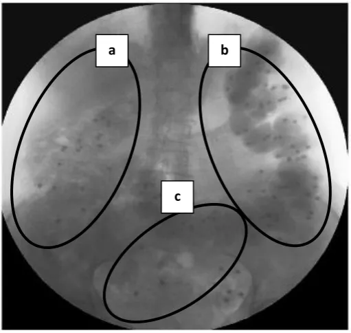 Figure 5: Fluoroscopic image showing small radio-opaque particles present in the different anatomical segments of the colon; a: right colonic segment; b: left colonic segment; c: recto-sigmoid colon