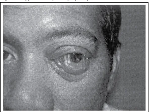 Figure 1: Appearance of the left eye at presentation