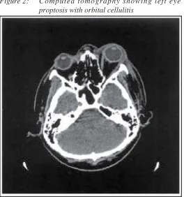 Figure 2:Computed tomography showing left eye