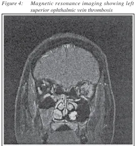 Figure 4:Magnetic resonance imaging showing left