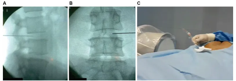 Figure 1 lateral (A) and anteroposterior (B) X-ray view and laser probe insertion (C) for percutaneous intradiscal laser decompression.