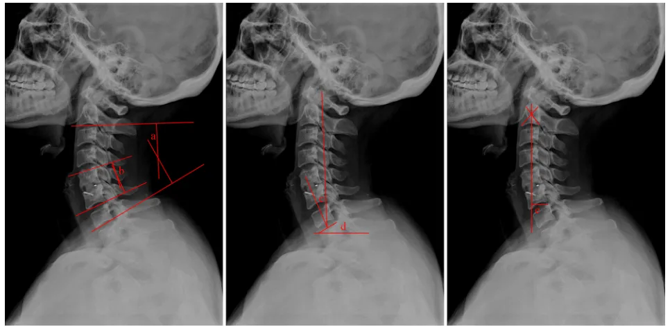 Figure 1 cervical sagittal alignment measurements.Note: a: c2–c7 cobb angle (cobb); b: the Fsa; c: cT; d: T1s and e: c2–c7 sVa.Abbreviations: c2–c7 sVa, c2–c7 sagittal vertical axis; cT, cervical tilt; Fsa, fused segment angle; T1s, T1 slope.