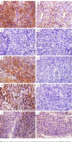 Figure 4. Representative immunohistochemical staining of CD29, CD44, nestin, CD133 and ALDH1 expression in Kaposi’s sarcoma tissues