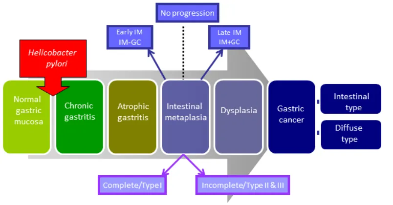 Figure 1: Progressive pathway to Gastric Cancer. First proposed by Correa, this schematic diagram outlines the progressive pathway to gastric cancer characterised by distinct histological changes