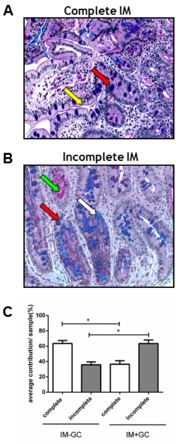 Figure 2: Classification of IM samples. All IM samples were stained with Alcian Blue periodic Acid Schiff (ABPAS) to ascertain the predominant IM subtype
