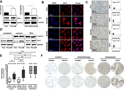 Figure 4: Mcl1 protein expression is elevated in docetaxel resistant cell lines, in prostate cancer, in metastatic lesions, and in patients after docetaxel chemotherapy