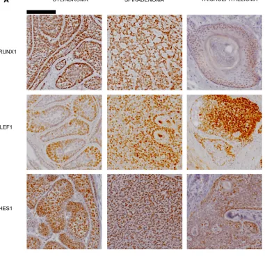 Figure 5: Expression of Notch target genes in CYLD defective tumours. (A) Tissue microarrays of cylindromas and spiradenomas and perilesional control skin were probed with anti-RUNX1, anti-LEF1 and anti–HES1 antibody and protein expression was visualized w
